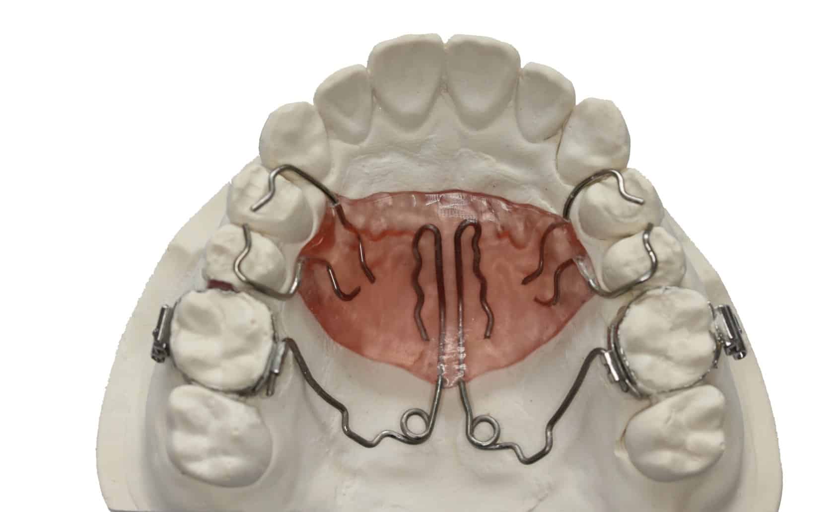 appareil orthodontie resine