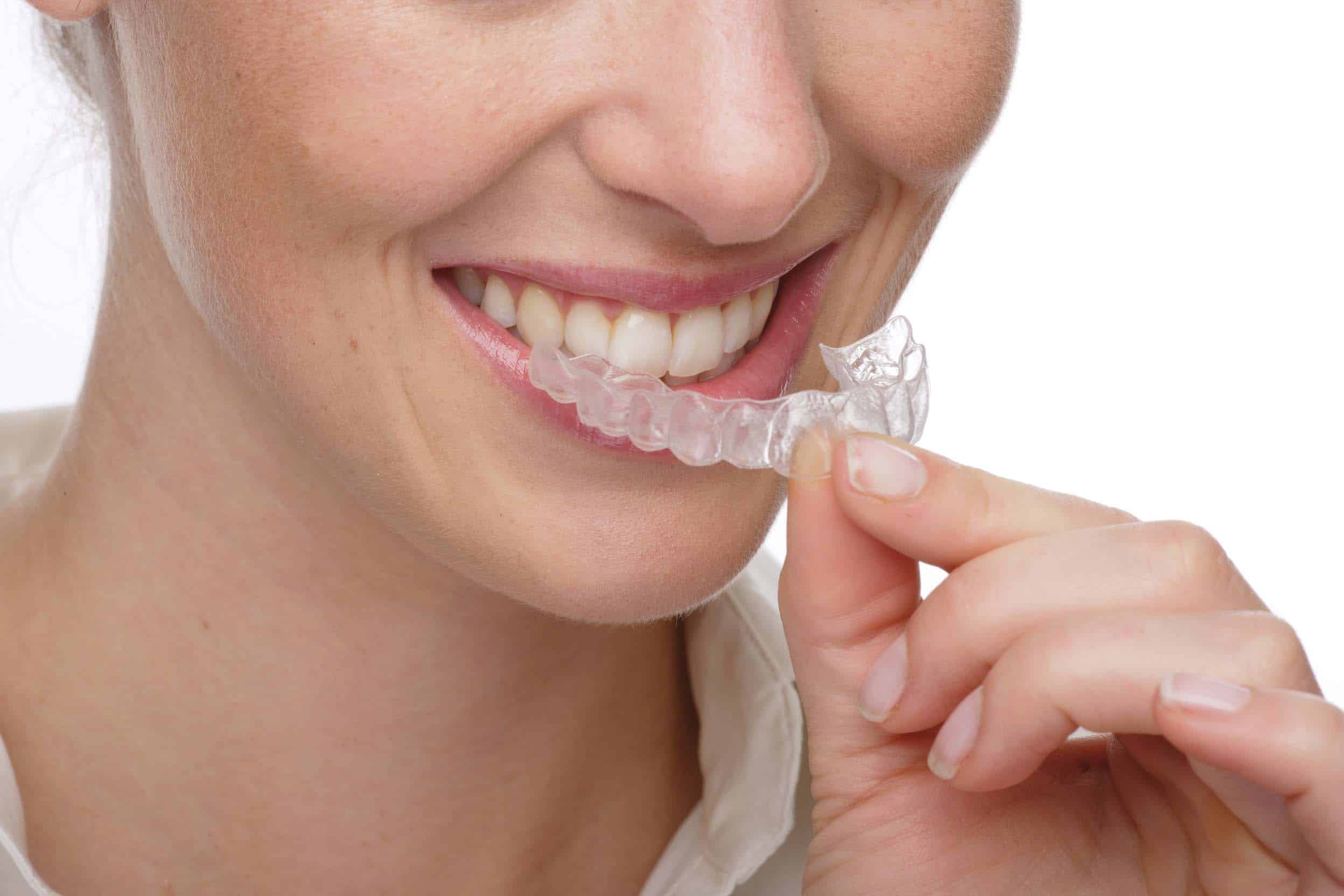 gouttieres invisalign