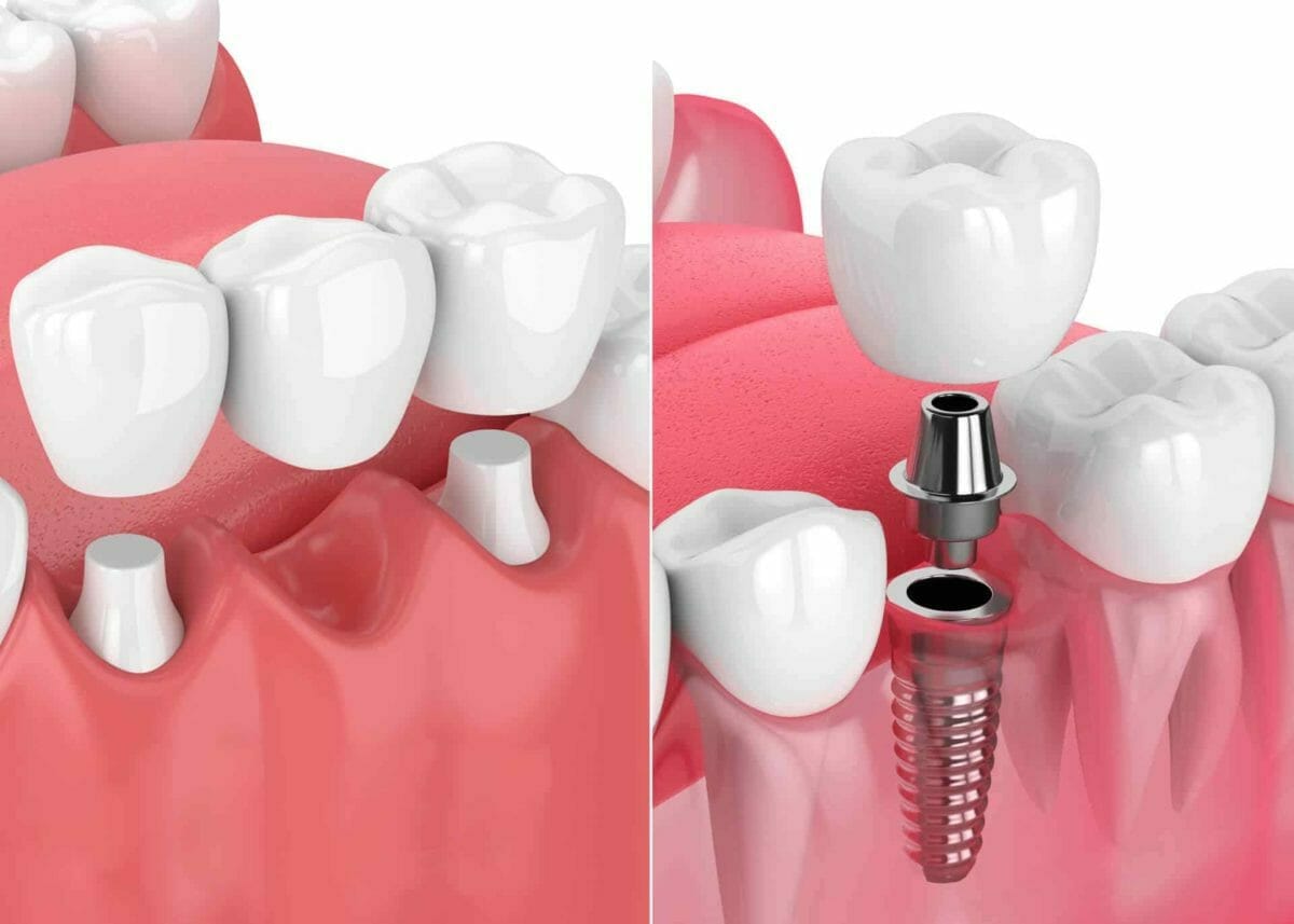 implant dentaire 1 implant dentaire 1 implant dentaire 1