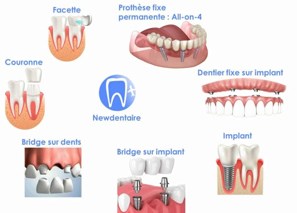 types de protheses dentaires