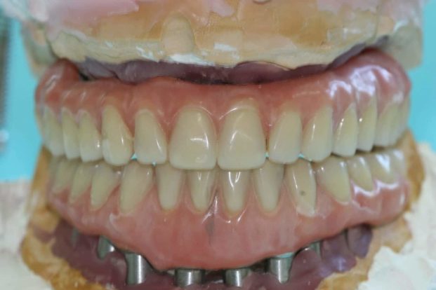 bimax implants bimax implants